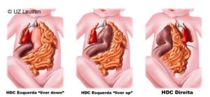 Classificação da hernia diafragmatica congenita