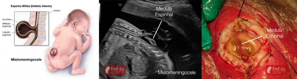 Espinha B Fida Fmfla Medicina Fetal