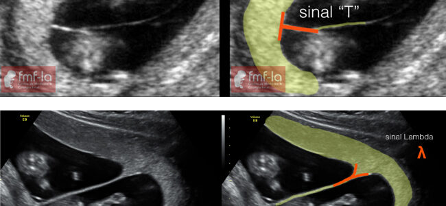 Síndrome Transfusão Feto Fetal FMFLA Medicina Fetal