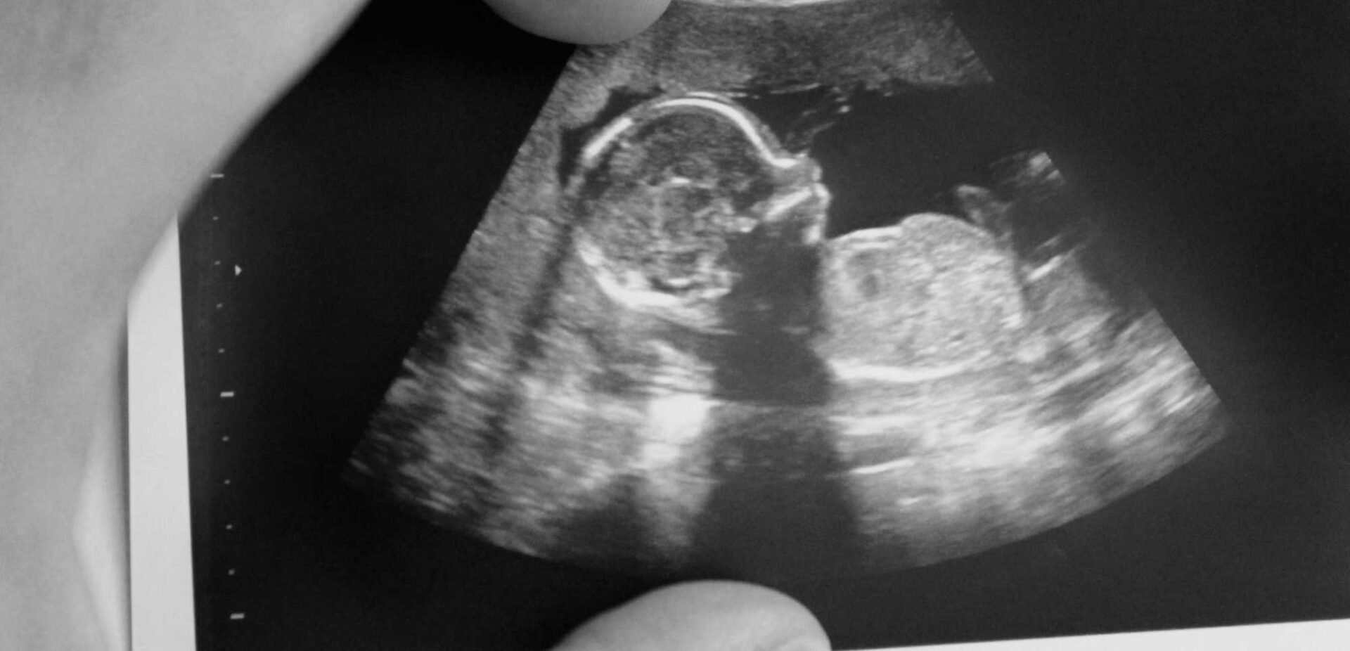 Ultrassonografia Trimestre FMFLA Medicina Fetal